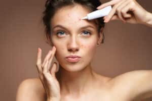 girl with problem skin applying treatment cream on beige background