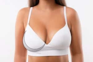 Close up of a woman’s chest with asymmetrical breasts and in need of breast reconstruction