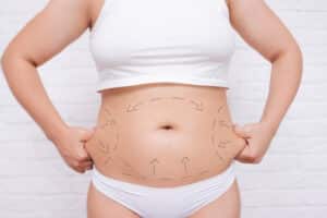 Woman's body with lines indicated liposuction areas
