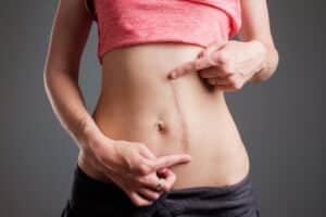 Woman pointing to long scar running vertically down her abdomen that could be improved with scar revision surgery
