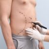 Plastic surgeon marking up a man's midsection to prepare for liposuction